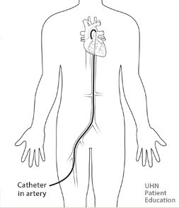 Diagram of a person with a catheter inserted in the femoral artery (groin area) and   going up to the heart.