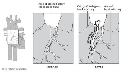  Heart with a close up of the coronary arteries. Before coronary artery bypass surgery,   image shows a coronary artery that is blocked up. After coronary artery bypass surgery,   image shows one end of a vein graft being attached to the aorta and the other end attached to   the artery just below the blockage. This bypass graft allows blood to return to the heart   muscle.