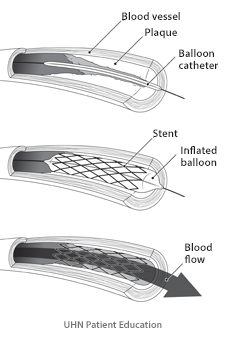  Coronary artery with plaque build up. Balloon angioplasty pushes   the plaque against the walls of the artery making the opening larger. A   stent is placed in the artery to hold the artery open.