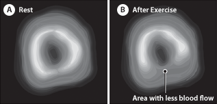 Two images of blood flow through the heart. Image A is a full circle showing   complete blood flow through the heart at rest. Image B is an incomplete circle showing   lack of blood flow through the heart with exercise.