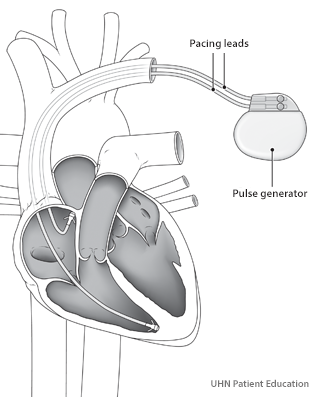 A picture of a pacemaker with leads placed in the heart.
