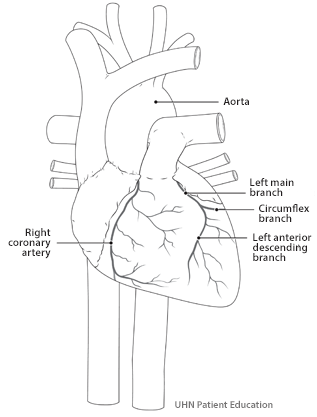 Image of a heart showing the coronary arteries and the aorta. Right coronary artery,   left main branch, circumflex artery and left anterior descending artery.