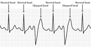  Image of an ECG showing a normal heart rhythm followed by an   irregular beat. Irregular beats are wider and look different than a normal   rhythm.