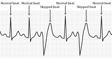 What is an Irregular Heart Beat?