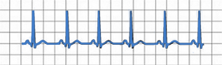 An ECG tracing showing a normal heart rhythm.