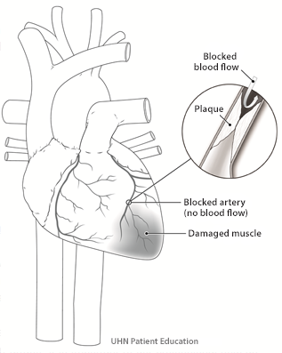 Image of heart showing a complete blockage of a coronary artery. Up close image of plaque rupturing into the artery blocking off blood flow and causing damage to the heart muscle.