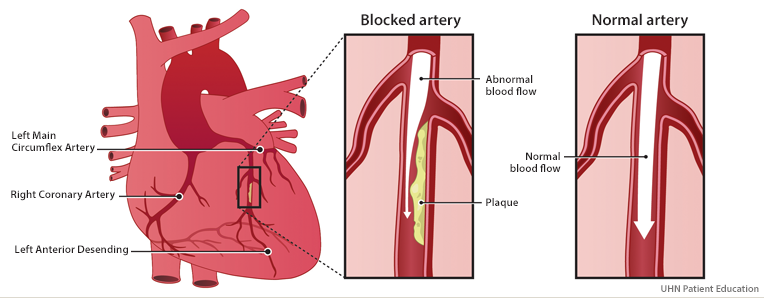 Image of heart showing plaque in the left anterior descending artery. The plaque is blocking off some of the blood flow. This is compared to a normal artery without plaque and blood is flowing freely.