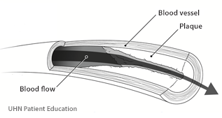 Image of plaque building up in the artery blocking off most of the blood flow.