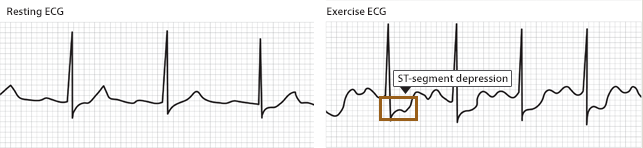 Two images. First image is of an ECG showing a normal heart rhythm at rest. Second image is of an ECG showing ST-segment depression during exercise.