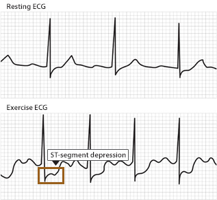 Two ECG tracings, one for a heart at rest one for a heart working. A segment of the working ECG tracing shows ST segment depression suggesting “ischemia” or lack of oxygen getting to the heart.
