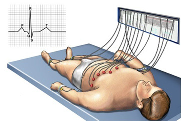 Diagram of man lying on table with ECG leads attached to his chest. Tracing of   heart rhythm is beside the man.